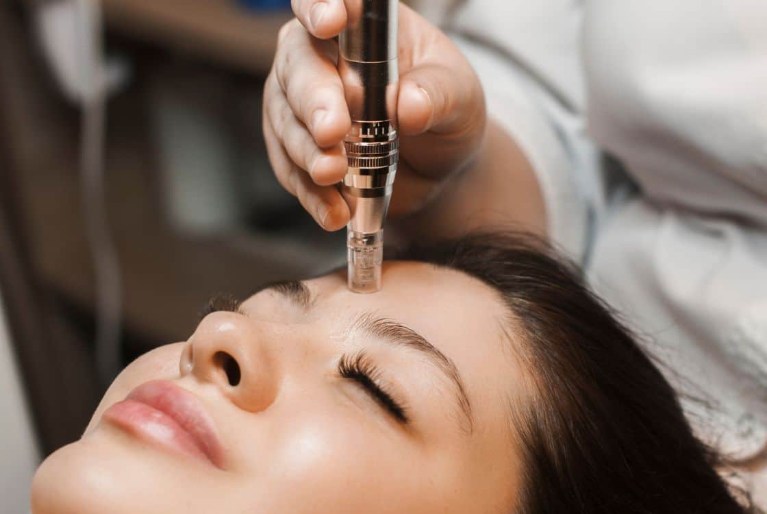 mujer en tratamiento de microneedling